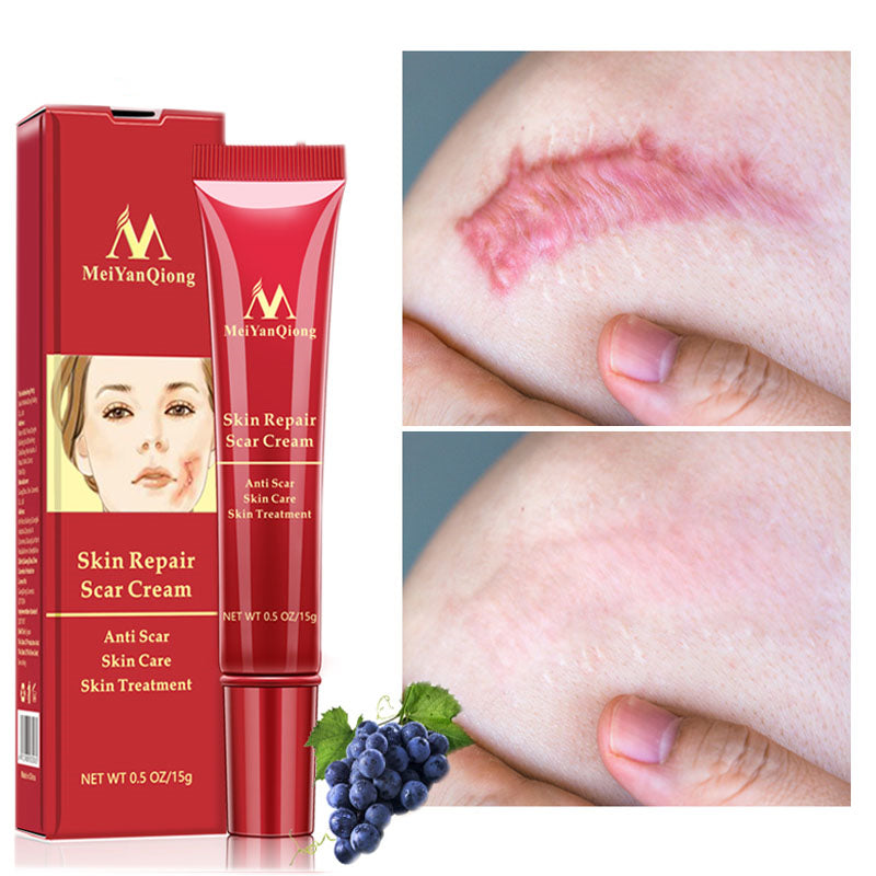Acne scar removal cream