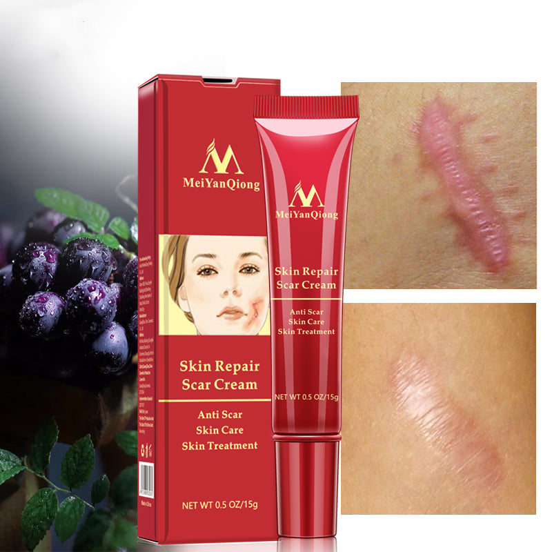 Acne scar removal cream